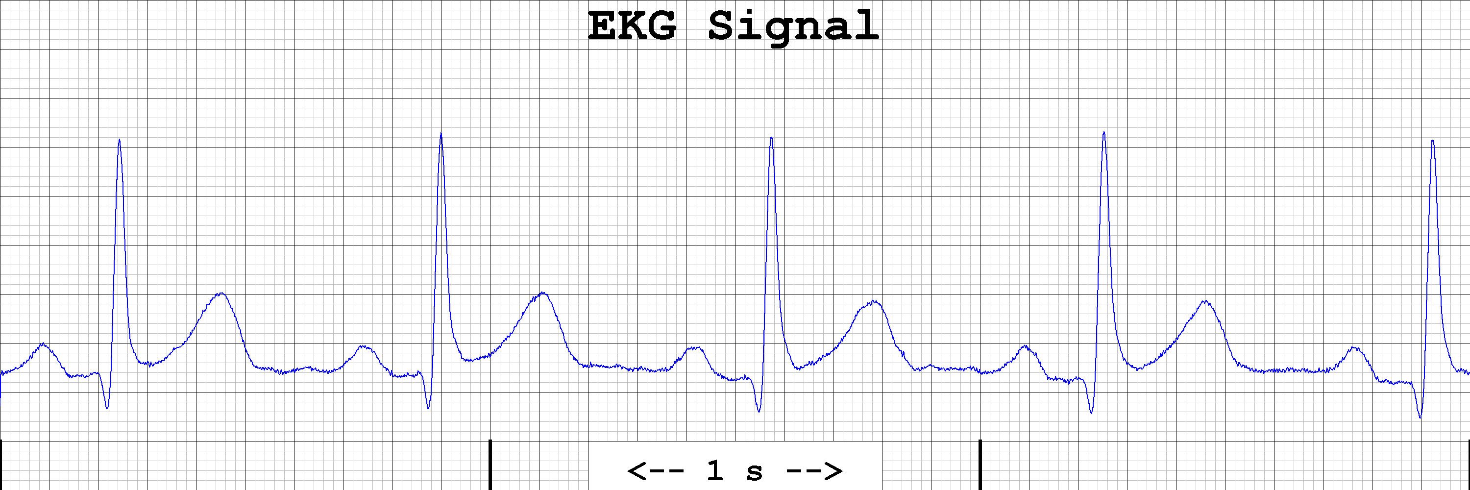 EKG Signal